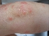 Дете от Русе заразено със западнонилска треска от комар
